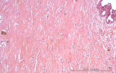 Аденомиоэпителиома молочной железы у кошки. Гистология. Рис. 10.