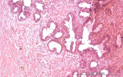 Аденомиоэпителиома молочной железы у кошки. Гистология. Рис. 11.
