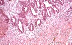 Аденомиоэпителиома молочной железы у кошки. Гистология. Рис. 12.