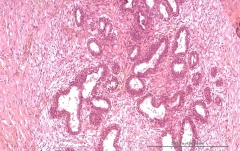 Аденомиоэпителиома молочной железы у кошки. Гистология. Рис. 13.