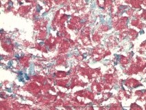Атипичный микобактериоз у собаки породы цвергшнауцер. Клеточный блок (cell-block). Окраска по Цилю-Нильсену. Рис. 21
