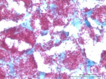 Атипичный микобактериоз у собаки породы цвергшнауцер. Клеточный блок (cell-block). Окраска по Цилю-Нильсену. Рис. 22