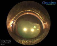 Цилиарная аденома задней камеры глаза у собаки породы лабрадор. Офтальмоскопия. Рис. 1