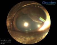 Цилиарная аденома задней камеры глаза у собаки породы лабрадор. Офтальмоскопия. Рис. 2