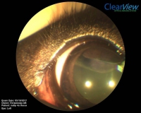 Цилиарная аденома задней камеры глаза у собаки породы лабрадор. Офтальмоскопия. Рис. 4