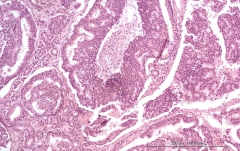 Дуктальная карцинома поджелудочной железы у кошки. Гистология. Рис. 14.