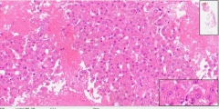 Гепатоцеллюлярный рак печени у кошки. Cell-block (клеточный блок). Рис. 8