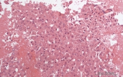 Гепатоцеллюлярный рак печени у кошки. Cell-block (клеточный блок). Рис. 9