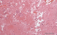 Гепатоцеллюлярный рак печени у кошки. Cell-block (клеточный блок). Рис. 10