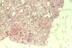 02 - Инфильтративная карцинома почечной лоханки с плоскоклеточной метаплазией у кошки породы петерболд.