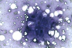 07 - Инфильтративная карцинома почечной лоханки с плоскоклеточной метаплазией у кошки породы петерболд. Традиционная цитология.