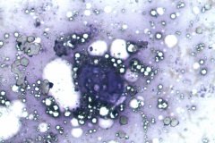 08 - Инфильтративная карцинома почечной лоханки с плоскоклеточной метаплазией у кошки породы петерболд. Традиционная цитология.