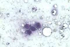 09 - Инфильтративная карцинома почечной лоханки с плоскоклеточной метаплазией у кошки породы петерболд. Традиционная цитология.