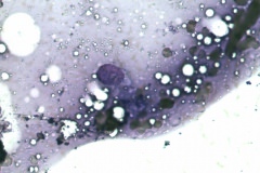 10 - Инфильтративная карцинома почечной лоханки с плоскоклеточной метаплазией у кошки породы петерболд. Традиционная цитология.
