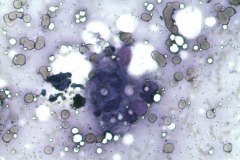 11 - Инфильтративная карцинома почечной лоханки с плоскоклеточной метаплазией у кошки породы петерболд. Традиционная цитология.