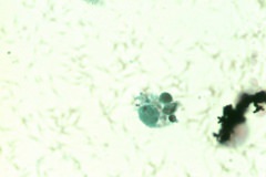 12 - Инфильтративная карцинома почечной лоханки с плоскоклеточной метаплазией у кошки породы петерболд. Жидкостная цитология.