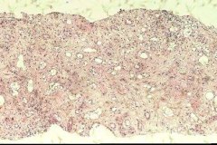 14 - Инфильтративная карцинома почечной лоханки с плоскоклеточной метаплазией у кошки породы петерболд. Гистология.