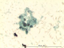 18 - Мастоцитома повышенной клеточности у собаки породы пудель.