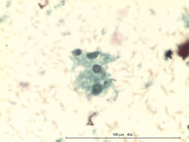 19 - Мастоцитома повышенной клеточности у собаки породы пудель.