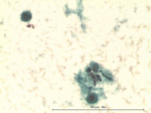 21 - Мастоцитома повышенной клеточности у собаки породы пудель.