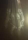 02 - Плоскоклеточный ороговевающий рак фаланги пальца у собаки породы ризеншнауцер. Рентген пальцев правой грудной конечности, прямая проекция.