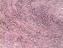 09 - Плоскоклеточный ороговевающий рак фаланги пальца у собаки породы ризеншнауцер. Гистология.