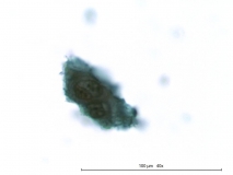 11 - Плоскоклеточный ороговевающий рак фаланги пальца у собаки породы ризеншнауцер. Жидкостная цитология.