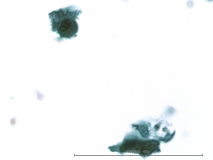 12 - Плоскоклеточный ороговевающий рак фаланги пальца у собаки породы ризеншнауцер. Жидкостная цитология.