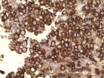 Т-клеточная лимфома у собаки породы бульмастиф. Экспрессия CD3. Рис. 5.