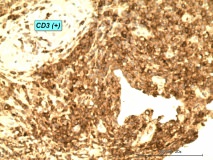 06 - Т-клеточная лимфома у собаки породы шарпей. Иммуногистохимия.