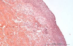 Листовидная пузырчатка у золотистого ретривера. Гистология. Рис. 18