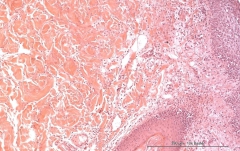 Листовидная пузырчатка у золотистого ретривера. Гистология. Рис. 19