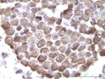 Мастоцитома кожи у мопса. Иммуногистохимия (антиген Mast Cell Try). Рис. 14