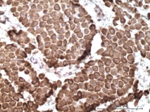 Мастоцитома кожи у мопса. Иммуногистохимия (антиген Mast Cell Try). Рис. 15