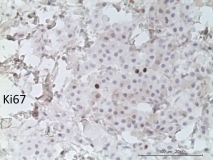 Мастоцитома кожи у мопса. Иммуногистохимия (антиген Ki-67). Рис. 16