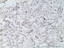 Мастоцитома кожи у мопса. Иммуногистохимия (антиген Ki-67). Рис. 18