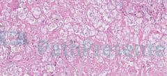 Некротический гранулематозный лимфаденит у кошки. Гистология. Рис 15