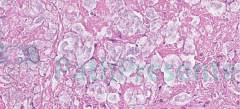 Некротический гранулематозный лимфаденит у кошки. Гистология. Рис 16