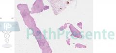 Некротический гранулематозный лимфаденит у кошки. Гистология. Рис 17