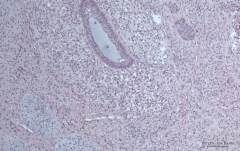 Одонтогенная опухоль у кошки породы мейн-кун. Фото 12. Гистология.