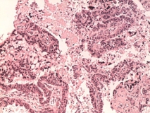 Папиллярная эндометриальная карцинома матки у кошки. Гистология. Рис. 19