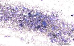Плоскоклеточная карцинома у хомяка. Цитология. Рис. 6