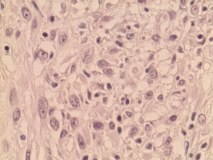 Пример фибросаркомы. Рис. 2. Гистология.