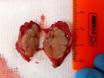 Злокачественная фолликулярная опухоль щитовидной железы у кошки. Фото 6. Новообразование в разрезе