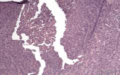 Злокачественная фолликулярная опухоль щитовидной железы у кошки. Фото 14. Гистология